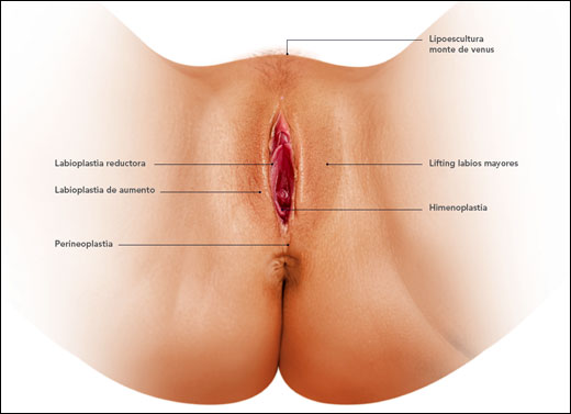 HIMENOPLASTIA