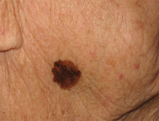 LENTIGO MALIGNO