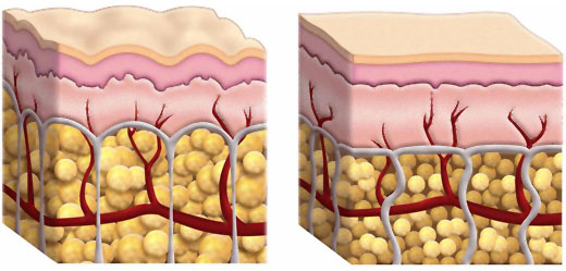 CELULITIS