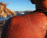 La cultura del bronceado y el daño actínico